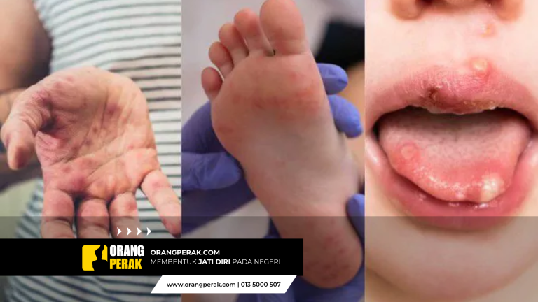 Wabak HFMD: Perak Tersenarai Antara 5 Negeri Tertinggi Kes 2025, Kanak-Kanak Berisiko